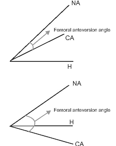 Clinical importance and sex differences of the femoral anteversion angle